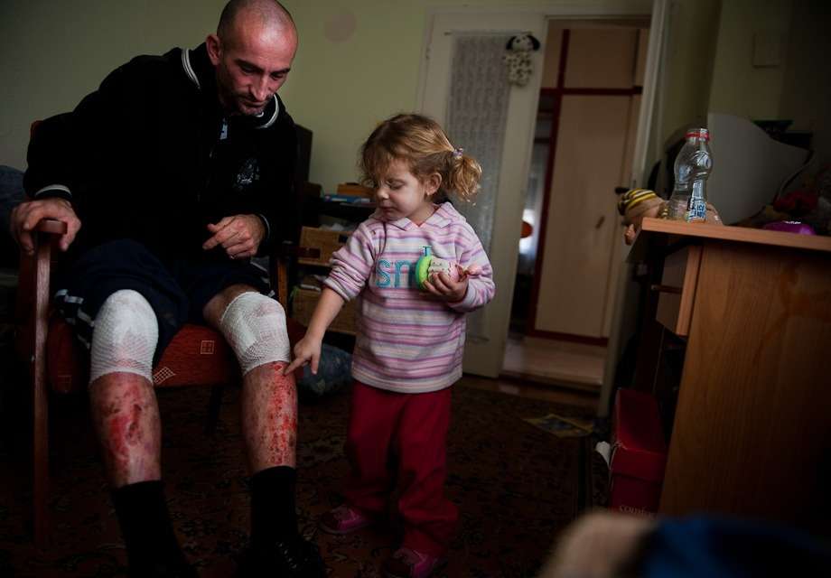 Juhász Zoltán vörösiszapban megégett lábát nézi kislánya a család átmeneti albér